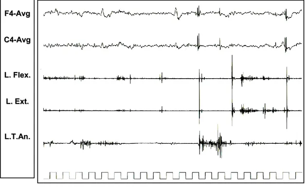 Figura  8:  Nel  paziente  2,  si  rilevano  (in  alto)  potenziali  muscolari  mioclonici  apparentemente non correlati ad eventi EEG; il back-average (in basso) dall’esordio 