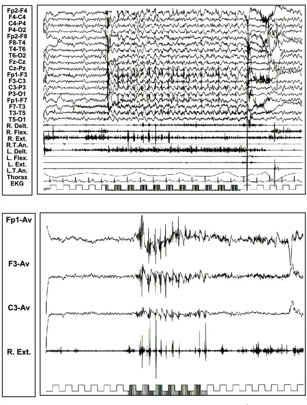 Figura  11:  Nel  paziente  1,  la  S.L.I.  alla  frequenza  di  stimolo  di  18  Hz  evoca  un  mioclono  focale  fotico  riflesso  (vedi  in  alto  e  il  particolare  in  basso)  con  coinvolgimento del muscolo estensore del carpo di destra