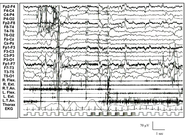 Figura  12:  La  S.L.I.  a  12-18  Hz  evoca  la  comparsa  di  fenomeni  mioclonici  diffusi  correlati ad anomalie epilettiformi diffuse (risposta fotomioclonica)