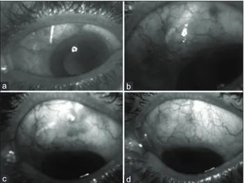 Figure 1: Patient with primary open angle glaucoma undergone 
