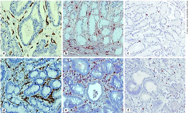 Fig. 3.  Immunohistochemical staining for CD31, tryptase, and chymase in stage II ( a–c ) and stage IV ( d–f ) hu- hu-man gastric cancer