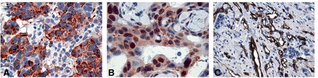 Figure 2. Immunohistochemical expression of VEGF (A), HIF-1 α (B), and CD31 (C) in bioptic samples of human breast cancer.