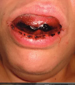 Figure 2: Clinical photograph of the extensive sublingual haematoma two hours after implant placement with the enlarged tongue (triple normal volume), displaced superiorly, pressed firmly against the palate, and protruding extraorally for 3 centimetres.