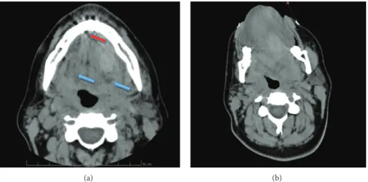 Figure 3: (a) Axial computed tomography image showing multiple areas of the whole mouth floor with different density (blue arrows) and the region of the cortical bone perforation (red arrow)