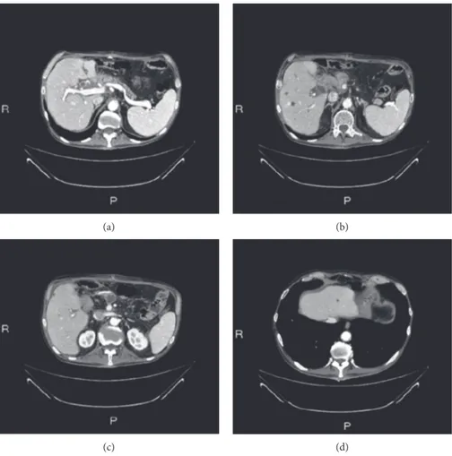 Figure 3: Radiological evaluation before surgery: primary pancreatic lesion (a) and liver metastasis (b–d).