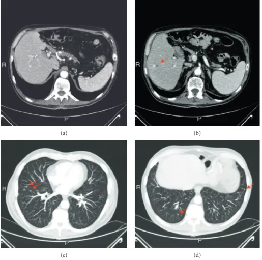 Figure 4: Disease relapse: radiological evaluation of primary pancreatic lesion (a), liver (b), and lung metastasis (c-d)