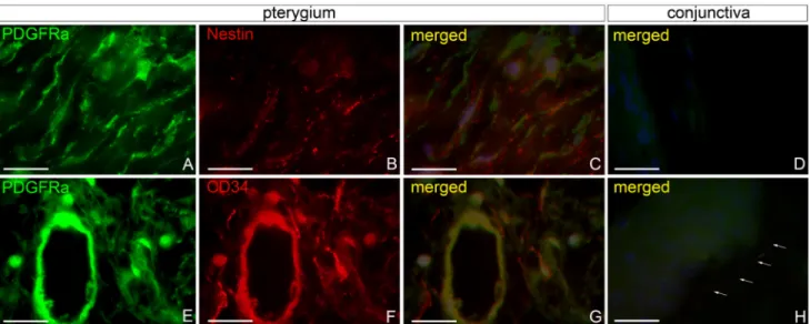 Figure 2. Double immunofluorescence labeling of TCs in pterygium and conjunctiva. A-D: double immunofluorescent reaction for PDGFRα  (green) and nestin (red); E-H: double fluorescence immunolabeling for PDGFRα (green) and CD34 (red)