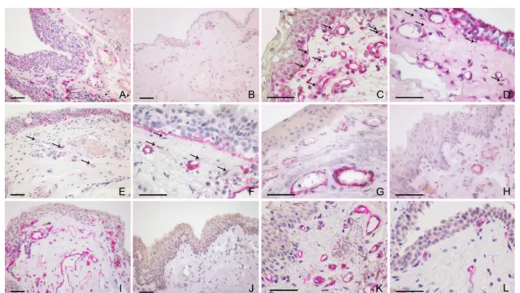 Figure 3. Immunohistochemical analysis of TCs in pterygium and conjunctiva. A,B: C-kit