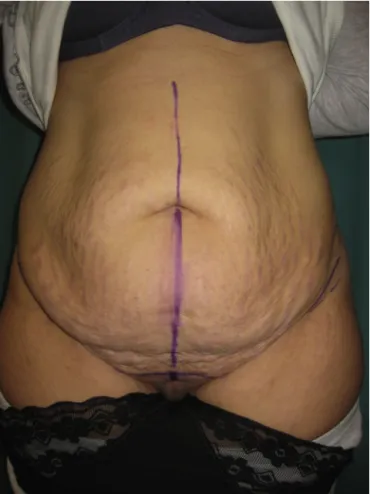 Fig. 2. Intra-operative photo. We can distinguee two different surgical plane: superﬁcial prefascial (above the Scarpa Fascia) in the infraumbilical region and preaneurotic region in the epigastric portion.