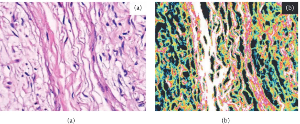 Figure 2: 150X. Traditional optical (a) and confocal laser scanning (b) analyses of a subcutaneous/nodular neurofibroma and its intense fluorescence due to the high content of neurofibromin in the well differentiated Shwann cells.