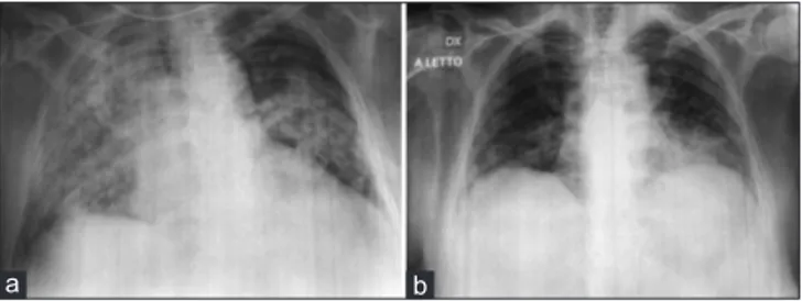 Figure 1: Two-projections chest X-ray performed the day of the admission 