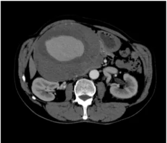 Fig 1. Preoperative computed tomography (CT) scan demon- demon-strates the large hepatic artery aneurysm (HAA).