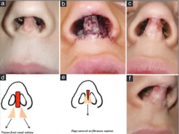 Figure 1: (a and b) Preoperative image of the necrotic columella and 