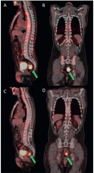 Figure 1 . 70-year-old male with a vegetans lesion at 7 cm  from the anal verge. Baseline ¹ 8 F-FDG PET/CT sagittal (A) 