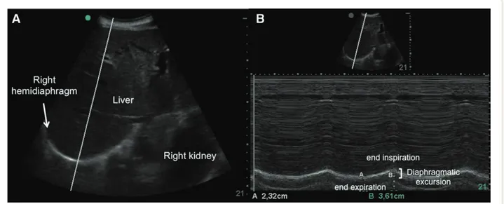 Fig. 1.  ultrasound images of the right hemidiaphragm. (A) A two-dimensional mode diaphragm picture: the bright curved line depicts the 