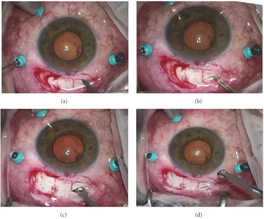 Figure 3: Intraoperative photographs (inverted image as seen by the surgeon). (a-b) Linear pars plana scleral access with max length of 3 mm is realized at 12 hours preserving the sites of trocars