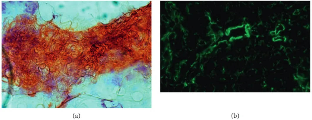 Figure 3: Amyloid deposition in periumbilical fat ((a)-Congo red) with apple-green birefringence (b) at polarized microscope analysis.