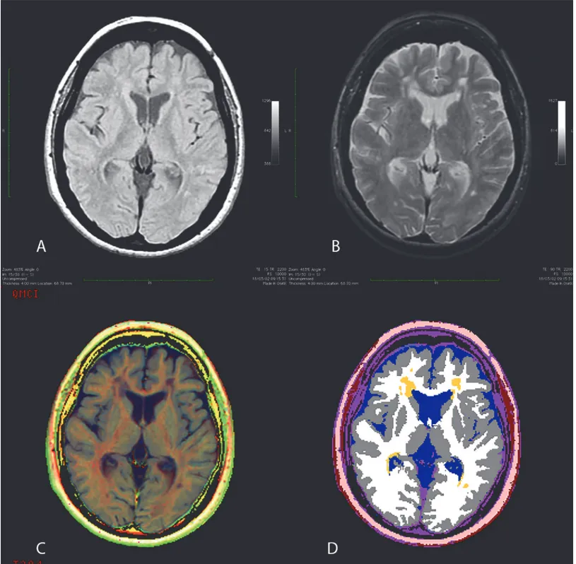 Fig 1. Axial image of a Multiple Sclerosis patient. (A) Proton density-weighted image; (B) T2-weighted image; (C) corresponding multiparametric image; (D) segmented image