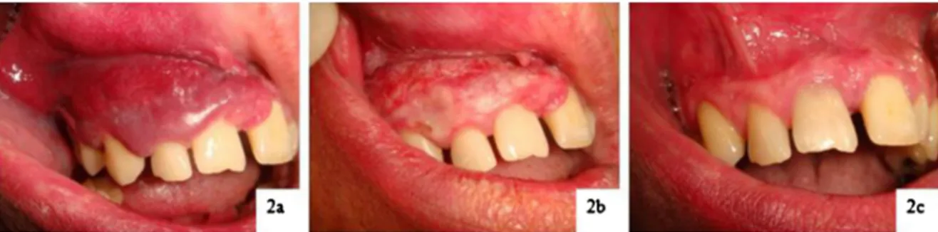 Fig. 2. A gingival lesion in region 2.1–1.8 before laser treatment (2a), after 2 Diode Laser Intralesional Photocoagulation sessions (2b) and after complete healing (2c).