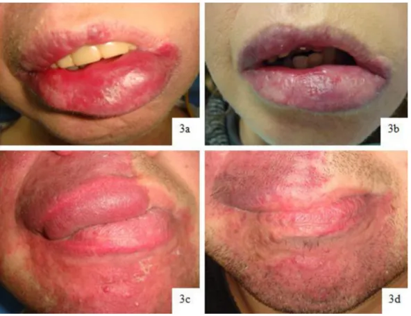 Fig. 3. (a) and (b). Case 1: haemangioma of lower lip before and after Diode Laser Intralesional Photocoagulation