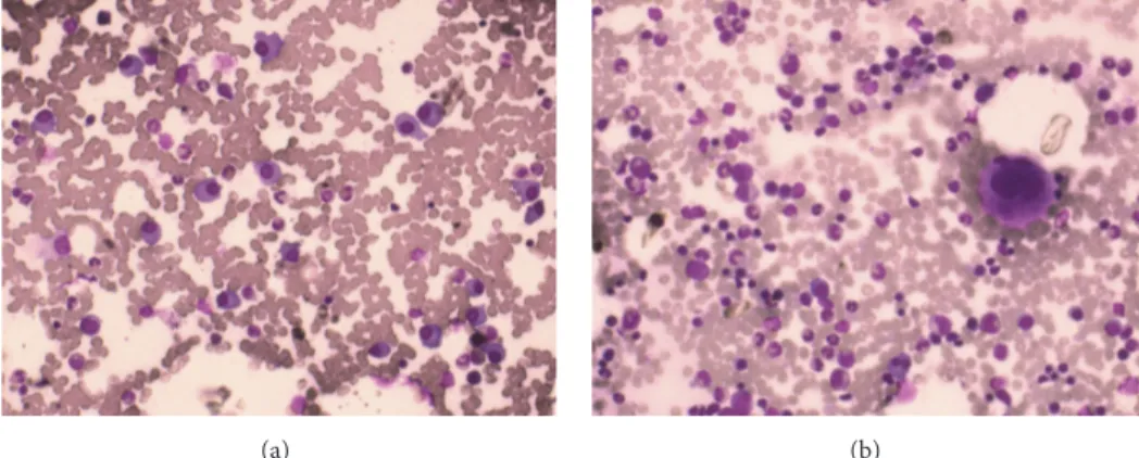 Figure 1: (a) May-Grunwald-Giemsa stain of bone marrow aspirate at diagnosis showing infiltrate of atypical plasma cells and (b) May- May-Grunwald-Giemsa stain after ASCT at VGPR showing reduction of the infiltration.