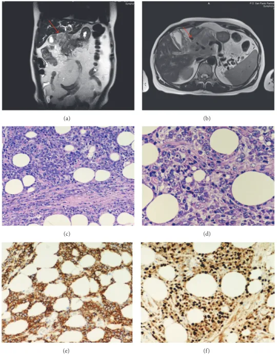 Figure 2: MR cholangiopancreatography before VBD therapy. (a) and (b) show a tumor mass localized at the hepatic hilum without cleavage