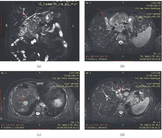 Figure 3: MR cholangiopancreatography after VBD therapy. Panels (a) and (b) show progression of extramedullary disease in the primary site (increase of dimension) and panels (c) and (d) show the appearance of new lesions in the liver.