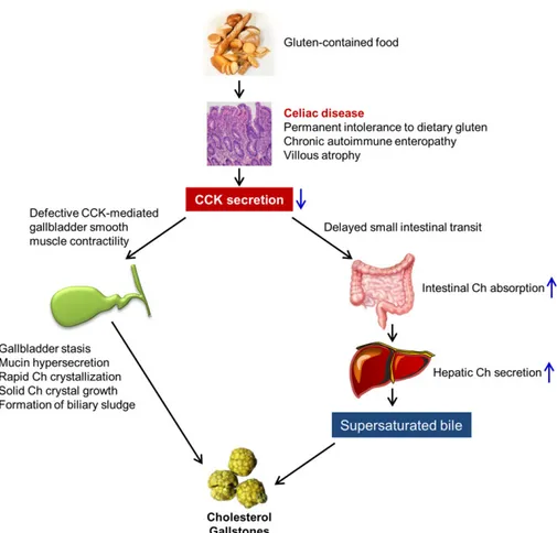 Figure 1 A working model elucidates the mechanism underlying the critical role of coeliac disease in cholesterol gallstone formation