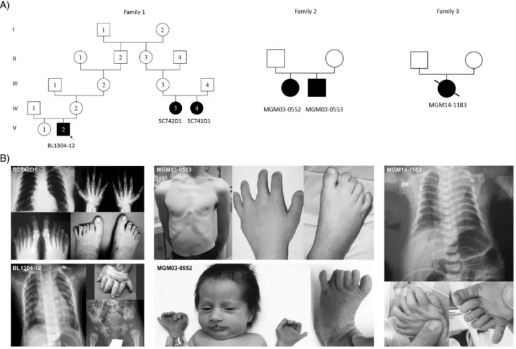 FIGURE 1 Family trees and clinical phenotype of the subjects with biallelic DYNC2LI1 mutations