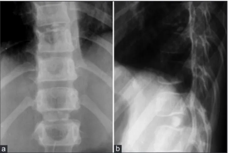 Figure  1:  Spine  X-ray  showed  disc  calcifications  in  D8-D9  and  D11-D12 as oval radiopaque spots in the rear part of intervertebral  spaces (a) Adjacent vertebral body plates showed mild impressions  coinciding with calcifications (b)