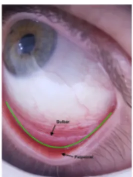 FIGURE 2. Bulbar and palpebral conjunctiva.