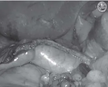 Figure 2 - Chemical omentoplasty: adhesion of the greater omentum to the staple line.