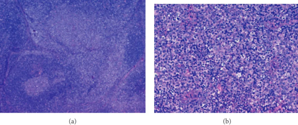 Figure 1: Histopathologic examination showing patchy areas of necrosis, numerous histiocytes, and apoptotic cellular debris