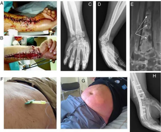Figure 1 The patient with compartment syndrome following open radial fracture stabilised with external ﬁxation (A)