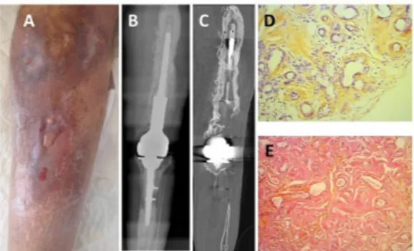 Figure 1  Chronic prosthetic joint infection of the left  leg causes AA amyloidosis. Clinical aspect of the left leg  after 13 years of chronic infection: cutaneous fistula with  purulent flow and inflammation of the dermis (A)