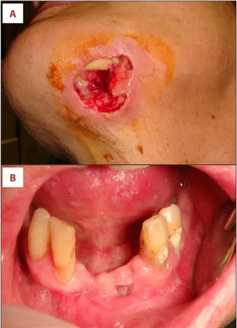 Figure 1.   Patient’s clinical features. Wide cutaneous necrotic  area ( A ) with bone exposure and pus discharge, and  ( B ) intraoral necrotic bone exposure on the anterior  mandible in a female patient affected by Crohn’s  disease, undergoing infliximab