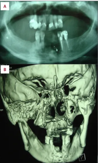 Figure 3.   Surgical treatment. Surgical removal of the necrotic  alveolar process ( A ); a iodoform gauze was put into  the external infected wound after debridement of the  cutaneous necrotic area ( B ).