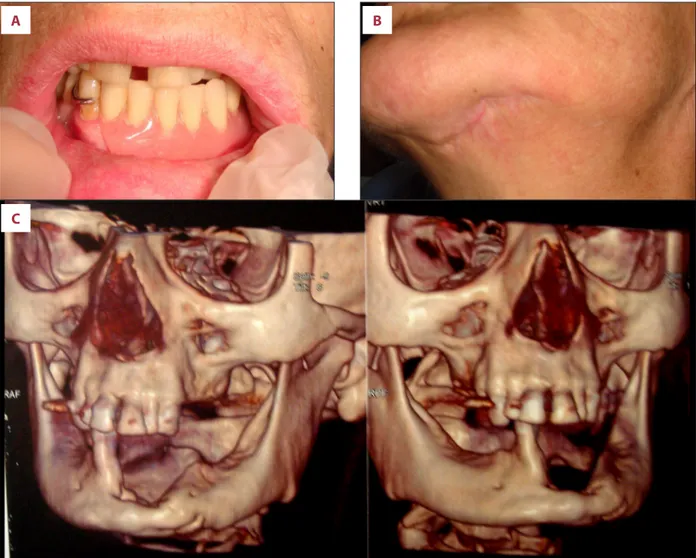 Figure 4.   Intra- and extra-oral wound healing. Rehabilitation with a removable prosthesis was chosen to guarantee function and  aesthetics ( A )