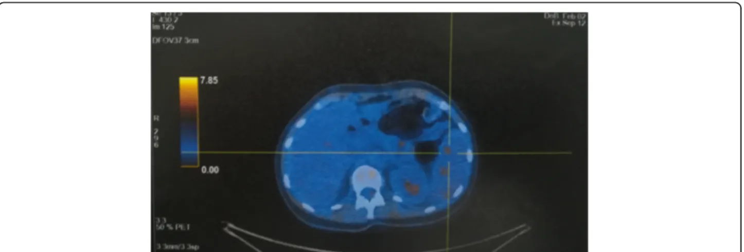 Fig. 2 CT/PET Total Body CT/PET Total Body shows hypercaptation of 18F-fluorodeoxyglucose (FDG) in the spleen