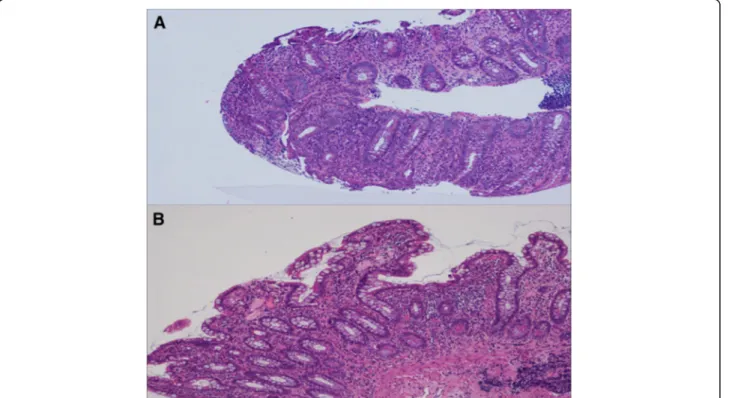 Fig. 4 Histological examination of the gut. Microscopy of the descending colon (a) and ileum (b) showing chronic inflammatory infiltrate, glandular distortion and aphthous erosions, all highly suggestive of Crohn ’s disease (hematoxilin and eosin, original