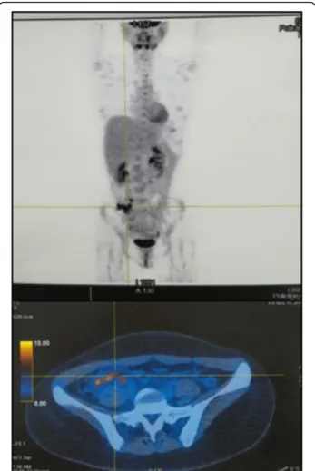 Fig. 5 Second CT/PET Total Body. The second CT/PET shows