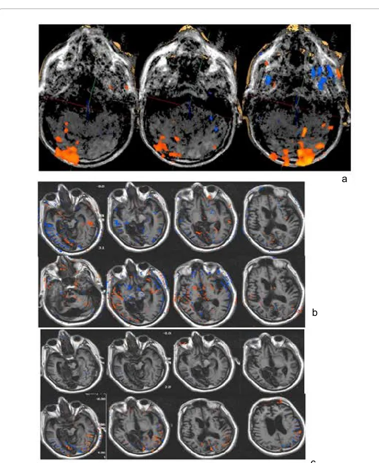 Figure 3: a: Listening to recorded messages by family voice was associated with cortical activation of the temporal, occipital and perirolandic regions on the left,  although the encephalic trunk evoked potentials were absent in the BAEP