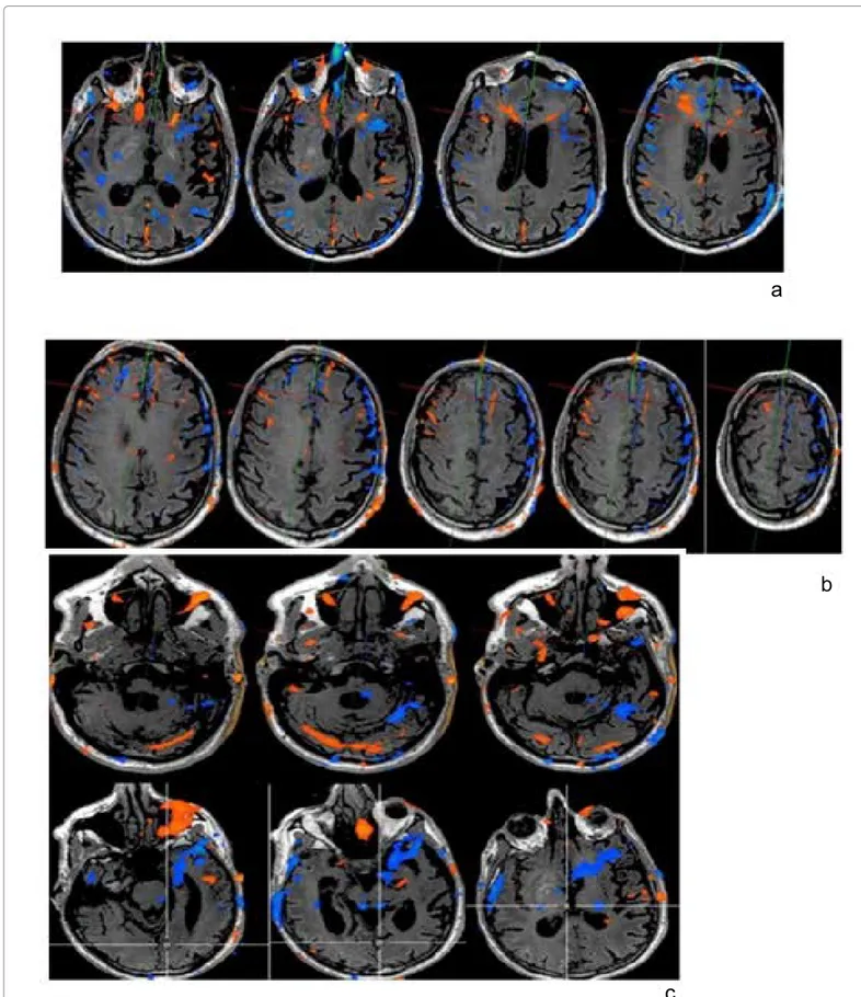 Figure 1: a: Listening to words (auditory task) is associated with activation of the cortex of bilateral temporal-island (more evident on the left) and frontal regions;  there is an activation of the mesial occipital cortex as well as in the prefrontal whi