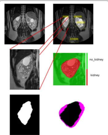 Fig. 10 Example result for ROI detection and semantic segmentation. Top left: the MR slice represented in greyscale; top right: the R-CNN detection result; middle left: one of the detected ROIs; middle right the segmentation result; bottom left: the ground