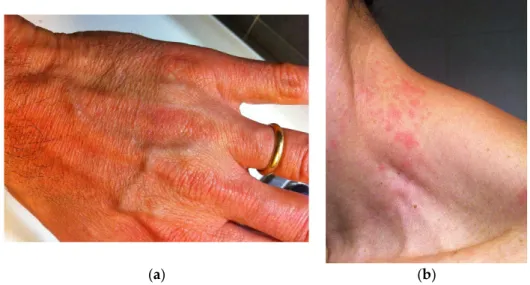 Figure 1. Rushes on skin of the (a) hand and (b) neck associated with fibromyalgia.  Conflicts of Interest: The authors declare no conflict of interest