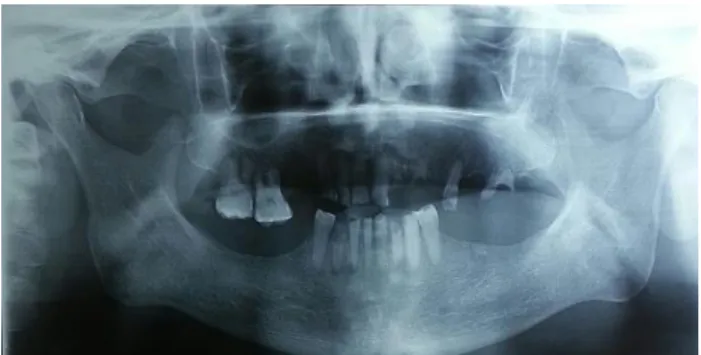 Figure 2: MRI Brain showing caudal displacement of  cerebellar tonsils through foramen magnum 