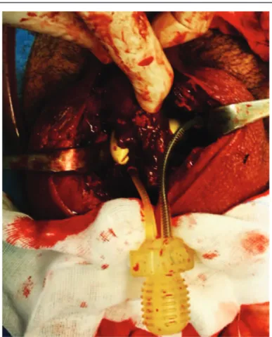 Figure 1. Large inguino-scrotal hematoma. Figure 2. Complete bilateral dehiscence of the sutures of the corpora cavernosa.