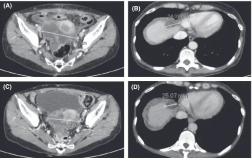 FIGURE 1  Abdominal CT scan at  the beginning of therapy with regorafenib  showed: (A) peritoneal mass localized in  recto‐uterine pouch (largest diameter of  95 mm); (B) liver metastasis at segment  VIII (largest diameter of 34 mm) (B)