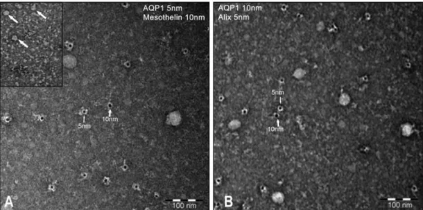 Figure 2. Nocturnal PD effluents from thirty PD patients were subjected to differential centrifugation to isolate an exosome-enriched fraction