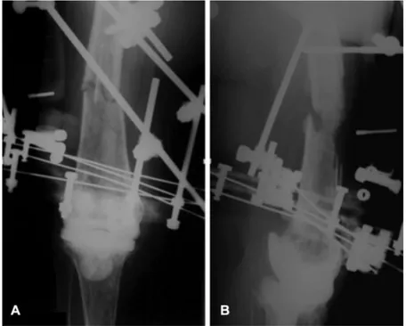 Fig. 5 Anteroposterior (A) and lateral (B) X-rays reveal a fracture at third distal of femur an atrophic nonunion.